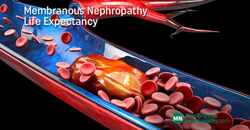 membranous-nephropathy-life-expectancy-membranous-nephropathy